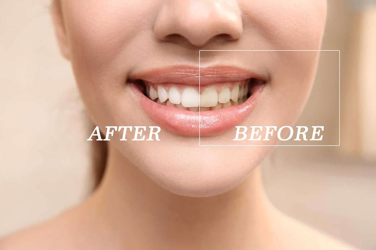 How Can You Maintain a Consistent Smile Shade with Crowns Rochdale?