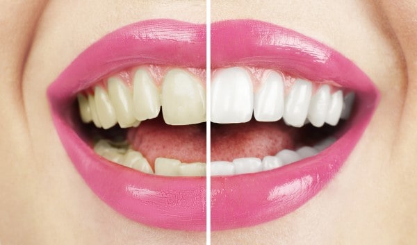 What Makes Ultima White Teeth Whitening Different Rochdale