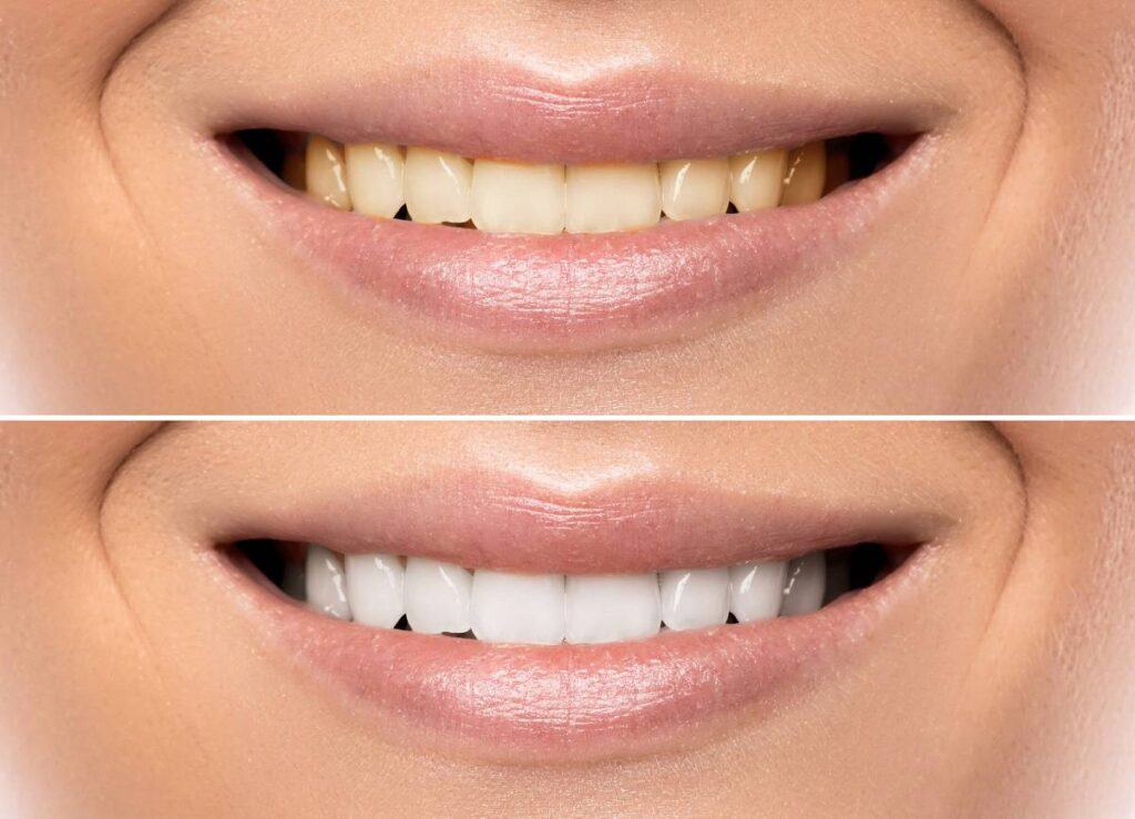 How Can You Protect Your White Smile as a Coffee Lover Rochdale?