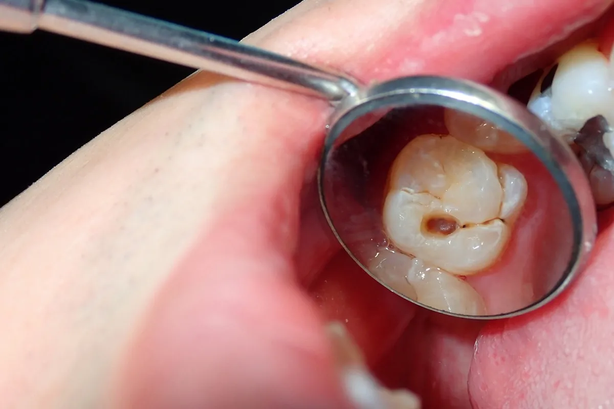 Why Do Teeth Crack? Common Causes to Know Rochdale