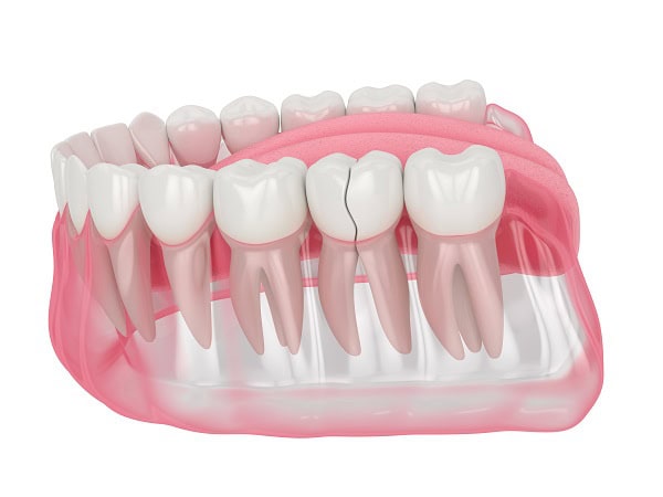 How Can You Manage Pain and Discomfort After a Root Canal Rochdale?