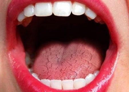 Common Causes of Dry Mouth (Xerostomia) Rochdale