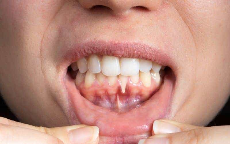 How Can Gum Disease Be Prevented Rochdale?