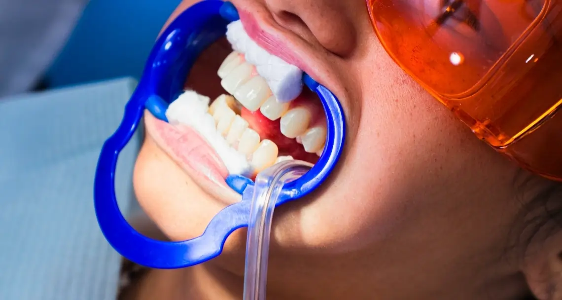 Is Laser Teeth Whitening Worth the Investment Rochdale?