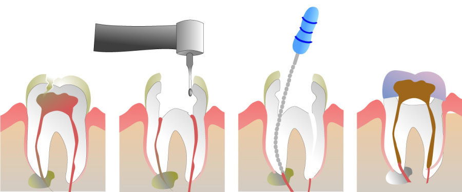 How Do You Properly Care for Your Teeth After a Root Canal Rochdale