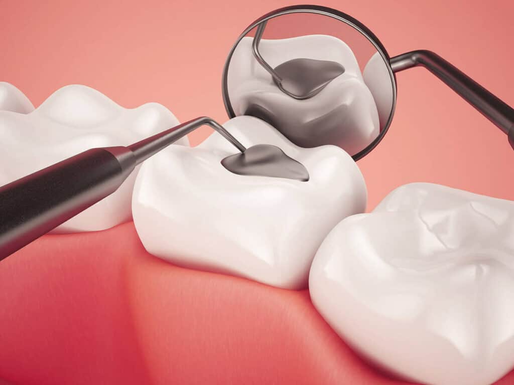 Fighting Cavities and Plaque Buildup Rochdale
