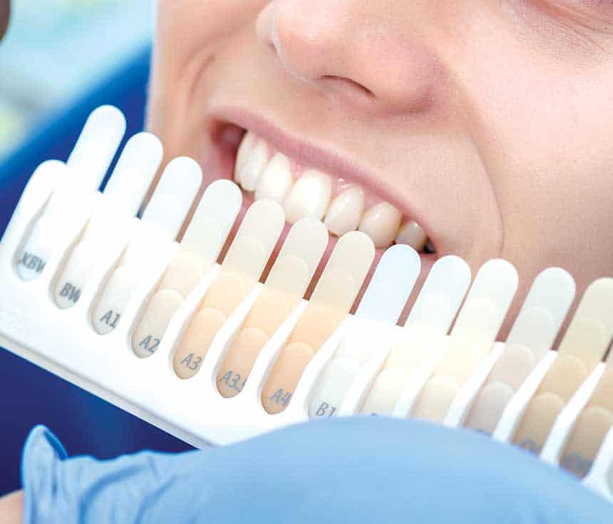 Professional vs At-Home Whitening: What You Need to Know Rochdale