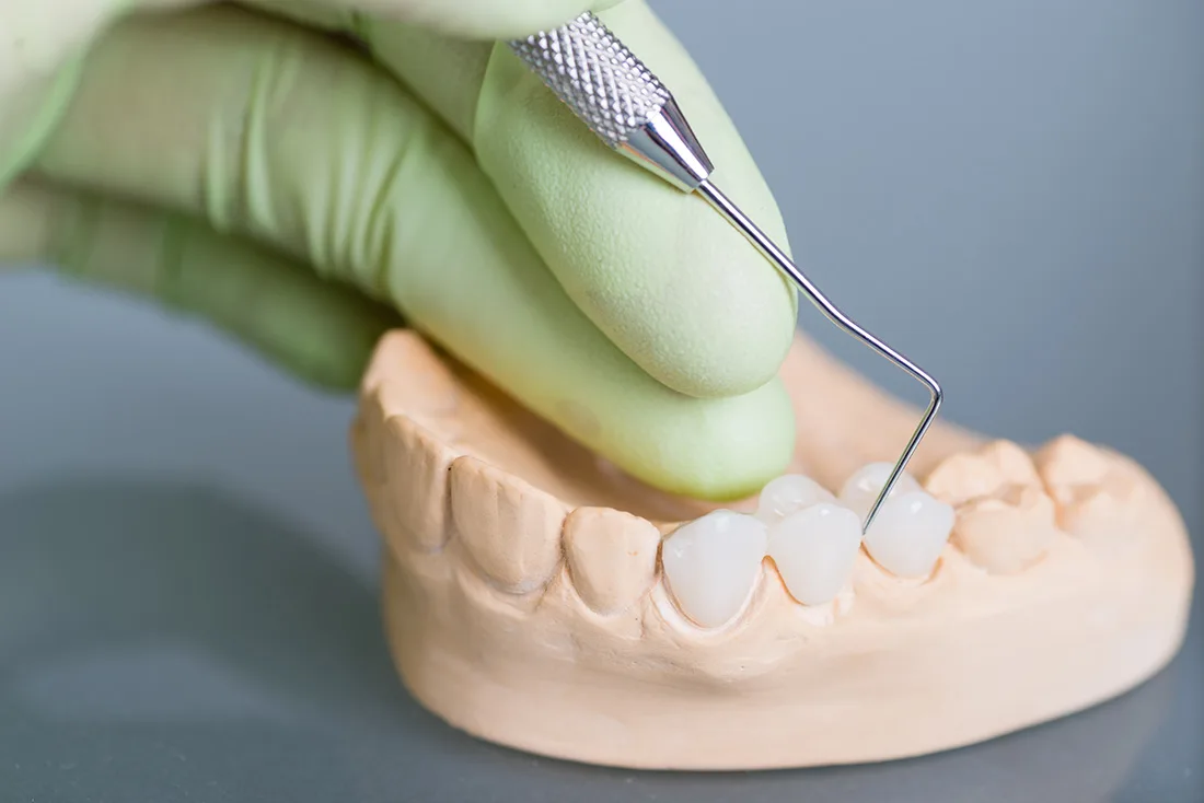 Do Braces Take Years to Show Results Rochdale