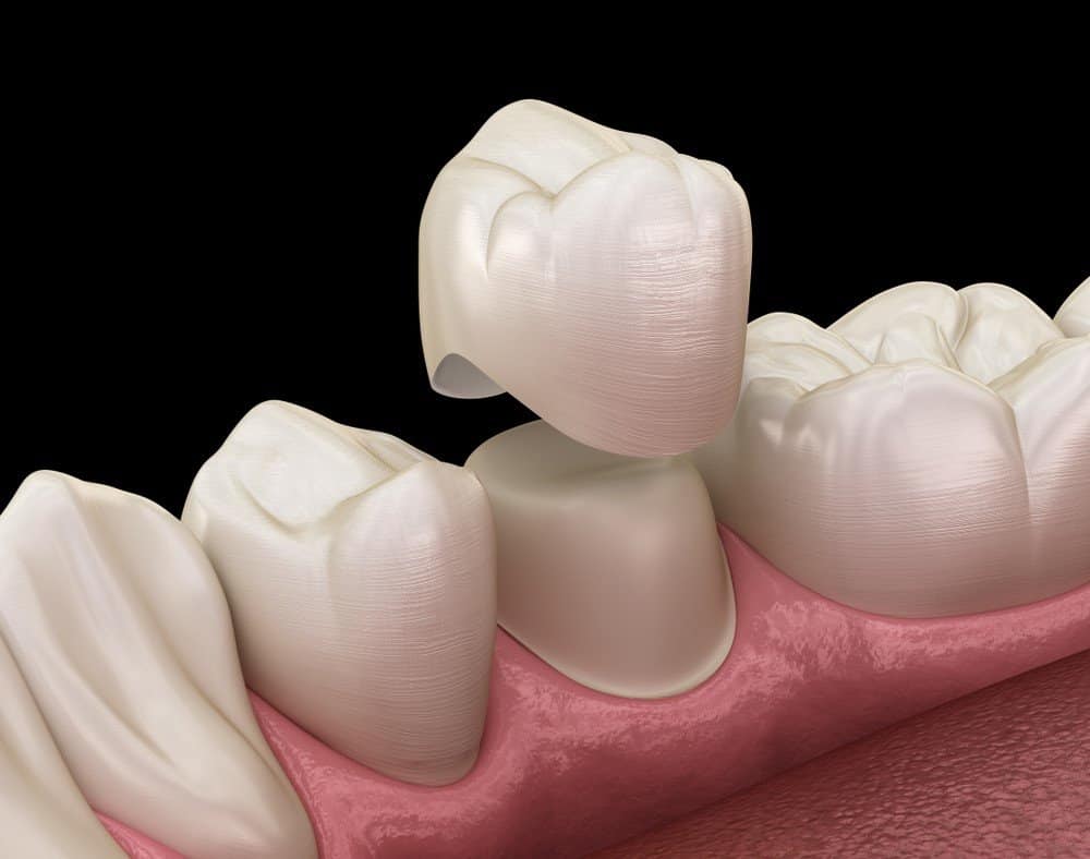 Teeth Whitening: Separating Facts from Fiction Rochdale