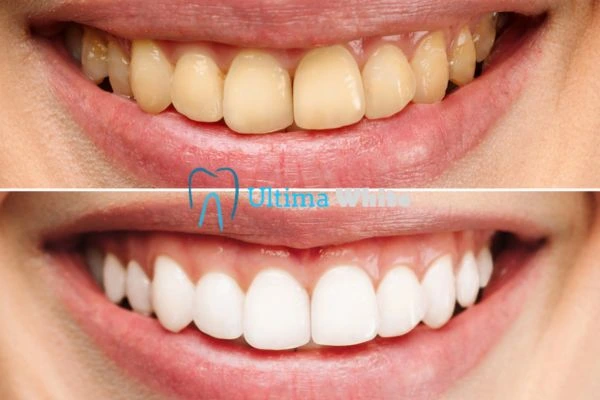 Oral Care Tips for Current and Former Smokers Rochdale