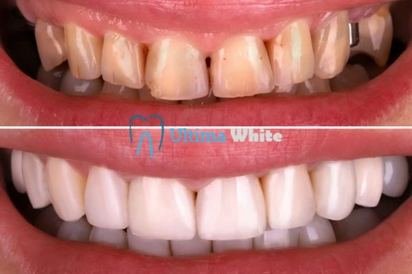 What Makes Instant Teeth Whitening Treatments So Popular Rochdale?