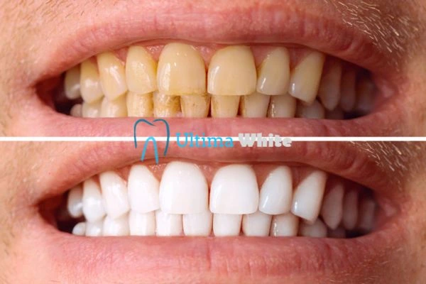 Stained Teeth and Persistent Bad Breath Rochdale