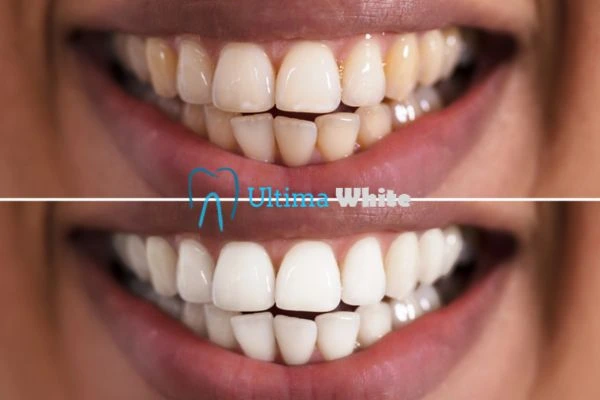 Aftercare Tips to Maintain Your New Smile Rochdale